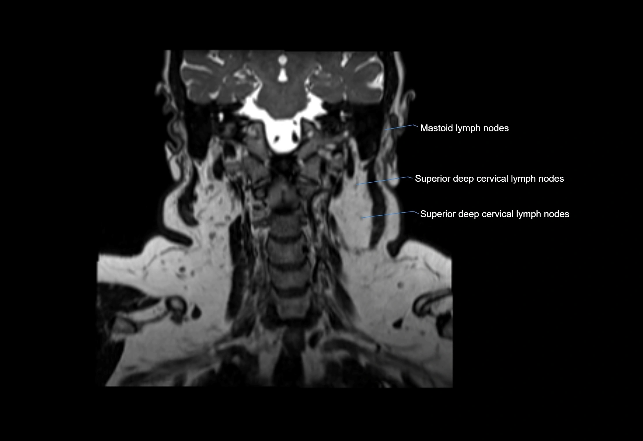 Neck coronal lymph node cross sectional MRI anatomy 3T MRI  image-img-00001-00029.webp